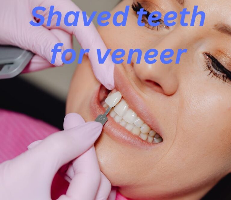 Every Thing Know About Shaved Teeth for Veneers